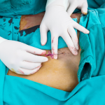 pantangan setelah pasang ring jantung